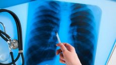 В Украине зарегистрировали около 1,7 тысячи случаев туберкулеза