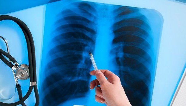 В Украине зарегистрировали около 1,7 тысячи случаев туберкулеза